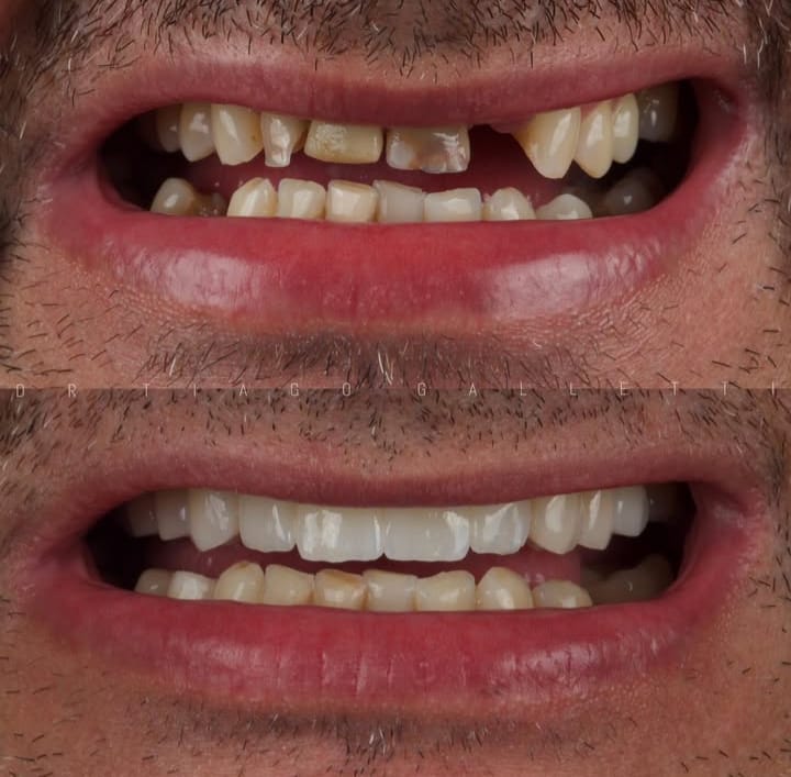 Caso 02 — antes e depois de reabilitação com implantes múltiplos no IOG